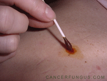 iodo melanoma